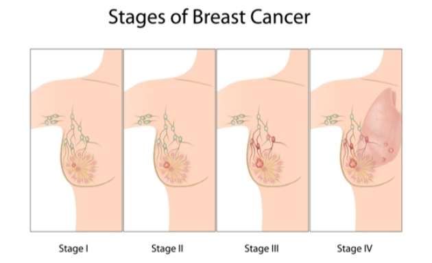 Breast-Cancer-Stages