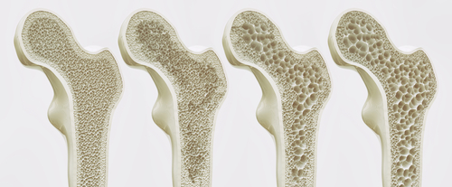 osteoporosis-when-even-sneezing-can-be-risky-pending