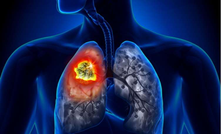 5-facts-about-lung-cancer