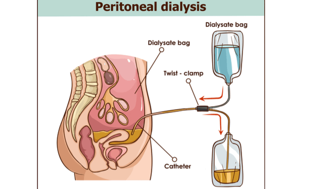 peritoneal-dialysis-kidney