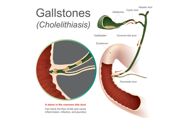 Gallstones-Diagram