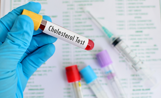 Lipid profile and cholesterol test