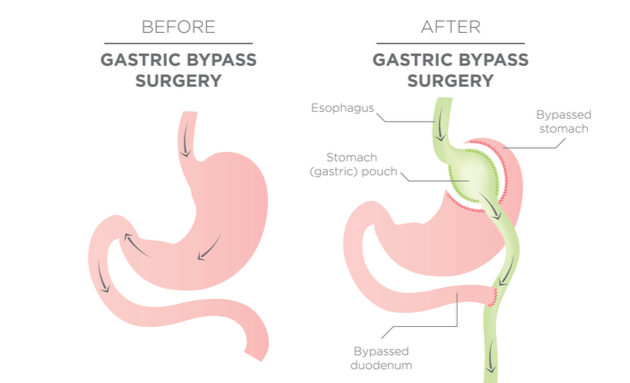 Bariatric-Surgery-Roux-en-Y-Gastric-Bypass