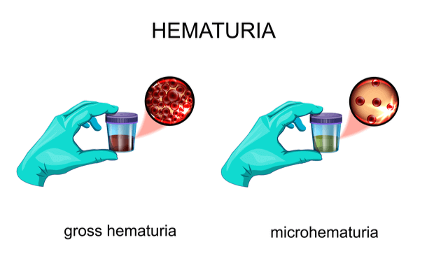 macro hematuria prosztatitis