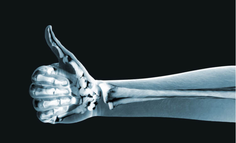 optimising-the-use-of-bone-density-tests-through-frax-scores