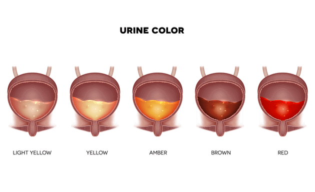 Urinary-Tract-Infection-UTI-Urine-COlor-Tesst