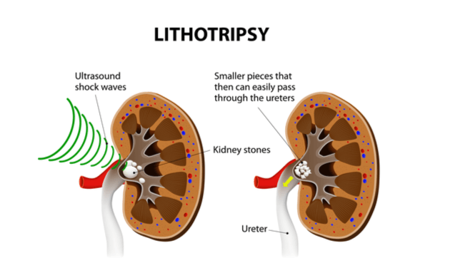 Kidney-Stone-Surgery-LITHOTRIPSY-SHOCKWAVE