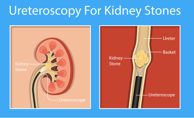Kidney-Stone-Surgery-URETEROSCOPY