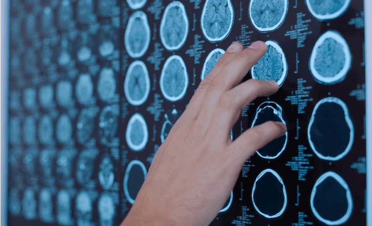 what-are-the-first-signs-of-a-brain-tumour