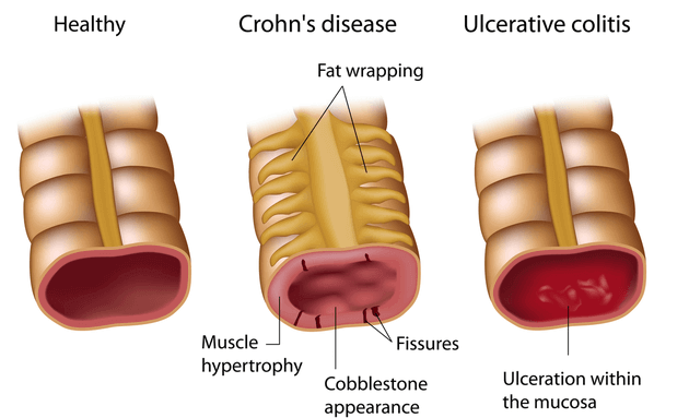 Inflammatory Bowel Disease (IBD) Why it can get worse and what to do
