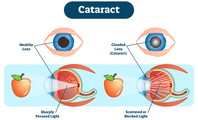 symptoms-of-cataract