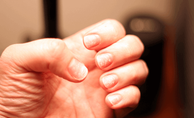 Brittle-nails