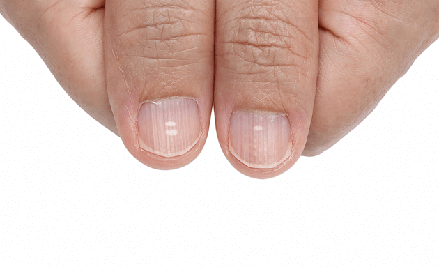 Ridges-on-your-nails