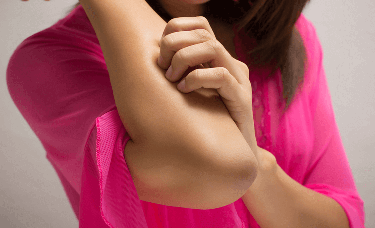eczema-and-your-skin-how-to-cope