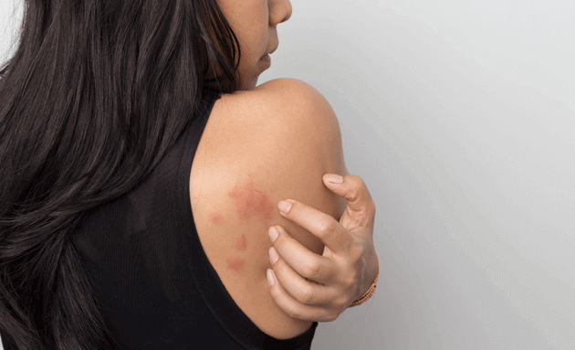 Symptoms-of-eczema