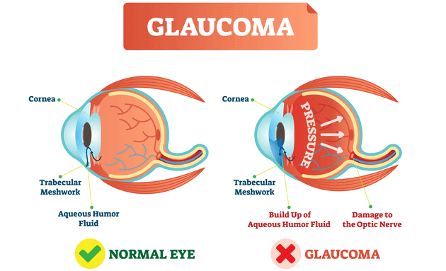 what-is-glaucoma