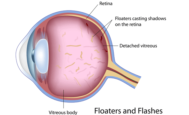 Symptoms-of-eye-floaters