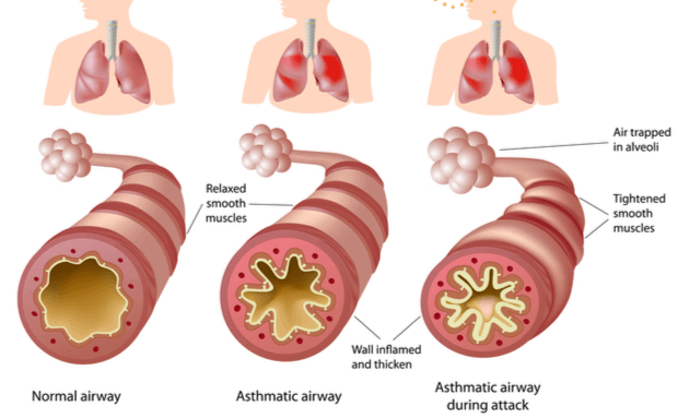 What-is-asthma