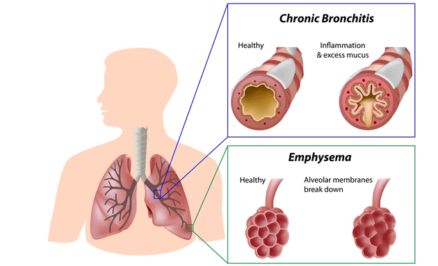 what-is-COPD