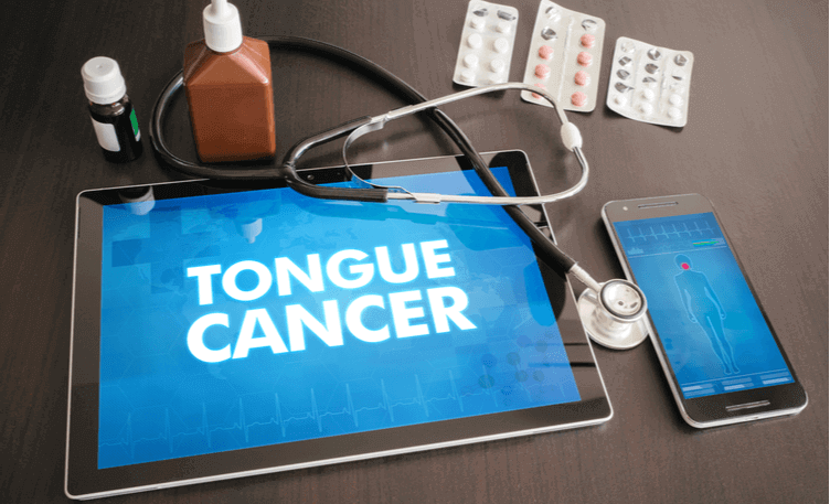 how-is-tongue-cancer-treated