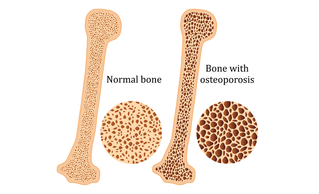 What-is-Osteoporosis