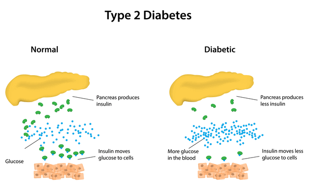 Type-2-diabetes