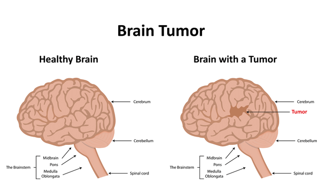 Brain-tumour-new