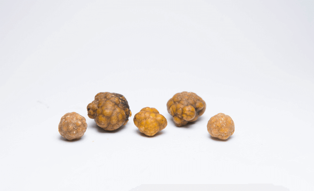 What-are-gallstones