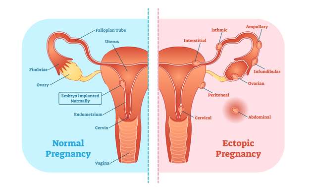Ectopic-pregnancy