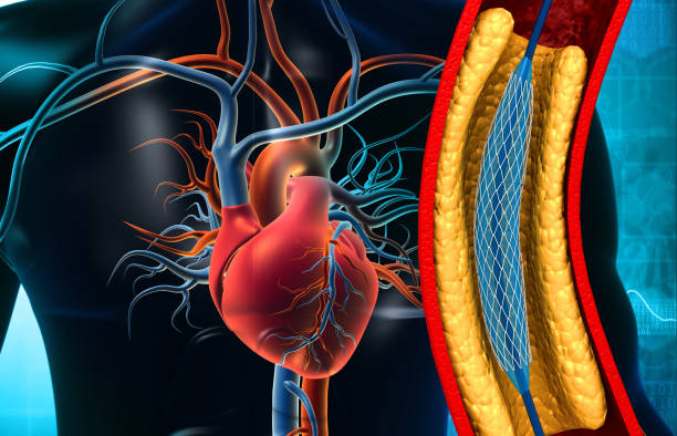primary-coronary-angioplasty-expanding-scenario-in-cardiac-interventions