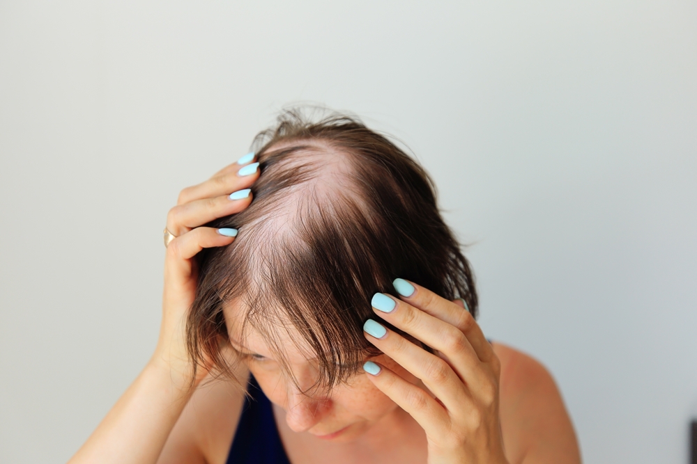 alopecia-areata-causes-symptoms-and-treatment