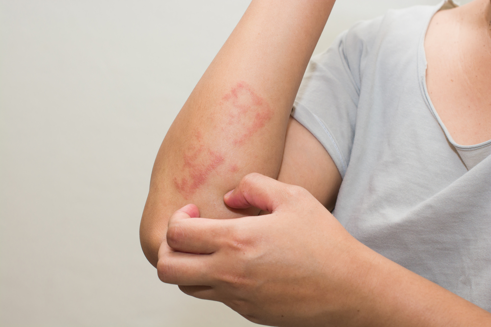 which-food-items-may-cause-allergies-and-rashes-on-your-skin