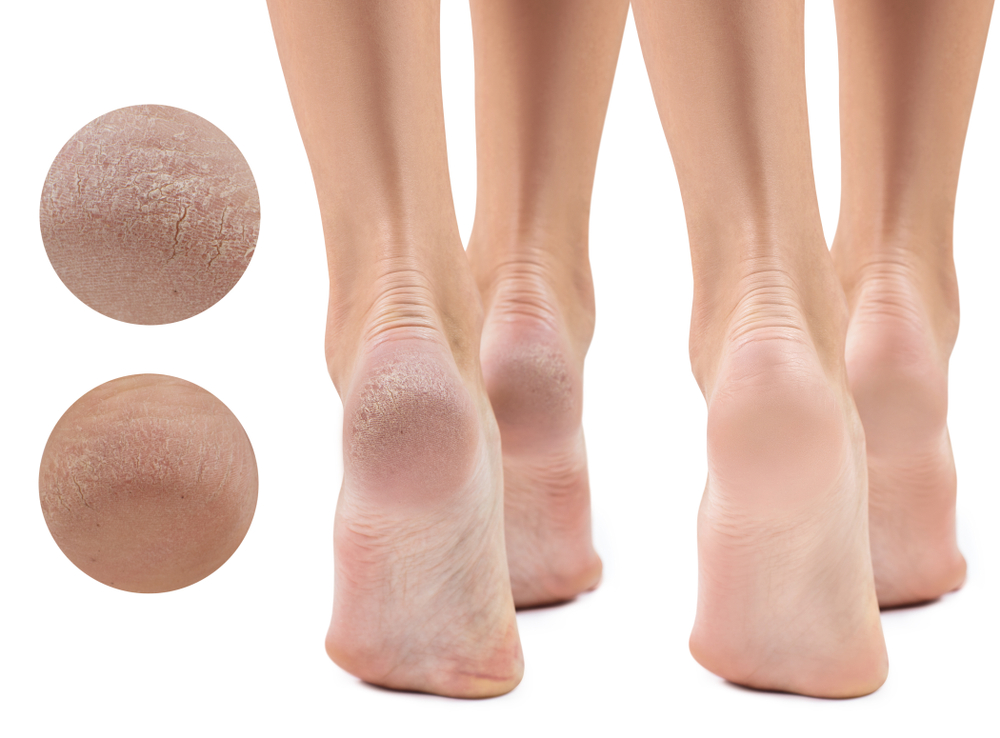 Cracked Heels - Kew Foot Clinic