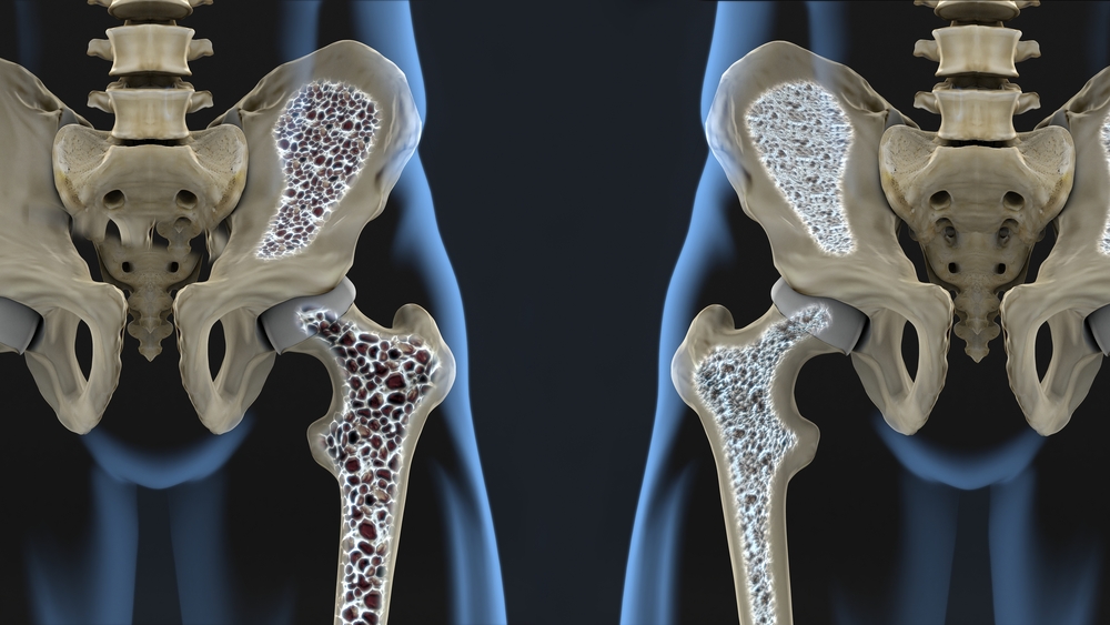 osteoporosis-symptoms-causes-total-guide