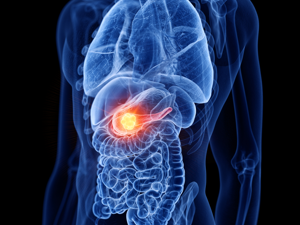 pancreatic-tumor-microbiome-related-with-poor-outcomes-medanta