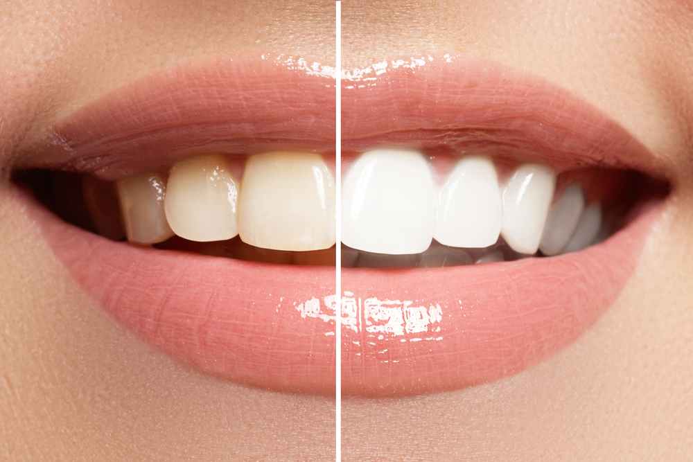 teeth-whitening-getting-the-perfect-glowing-smile