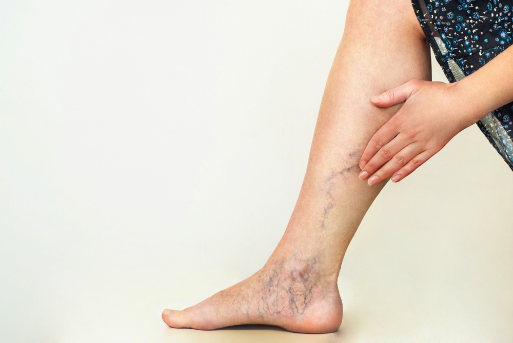 how-to-prevent-varicose-veins-lifestyle-changes-and-self-care-tips