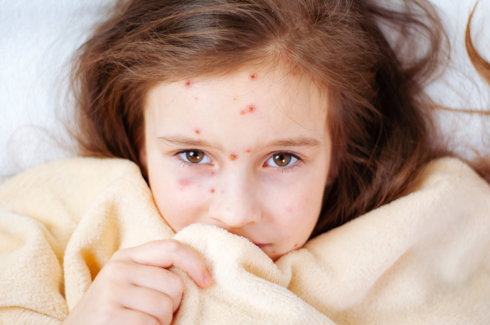 know-how-to-shield-children-from-the-dangerous-measles-during-an-outbreak