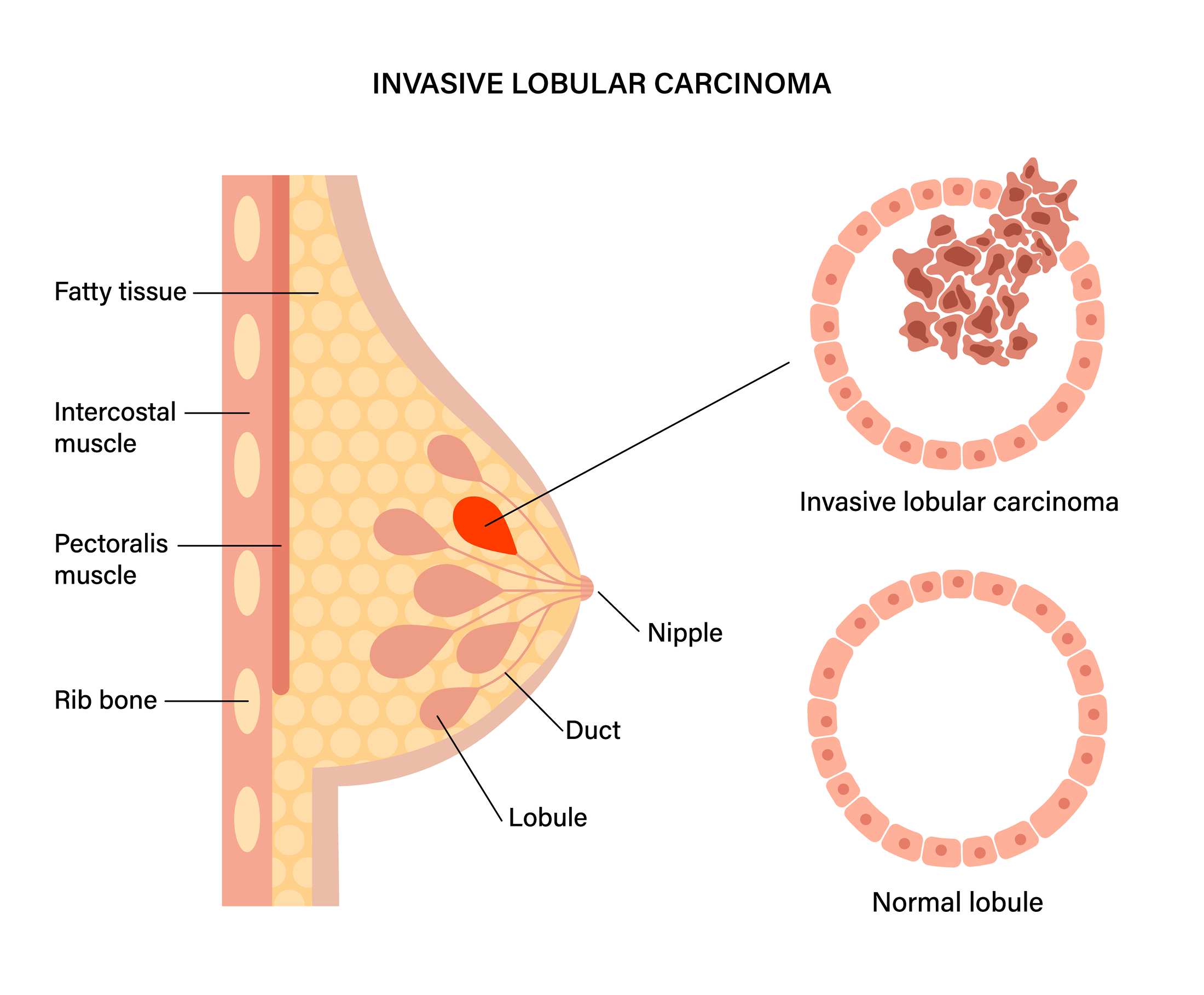 invasive-lobular-carcinoma