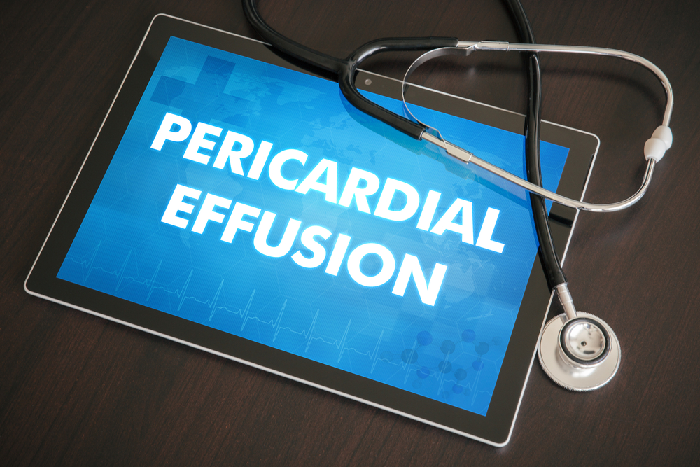 pericardial-effusion---symptoms-and-causes