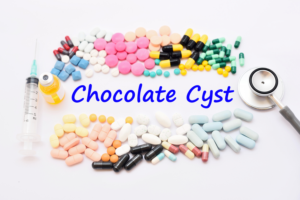 what-is-chocolate-cyst-ovarian-endometrioma