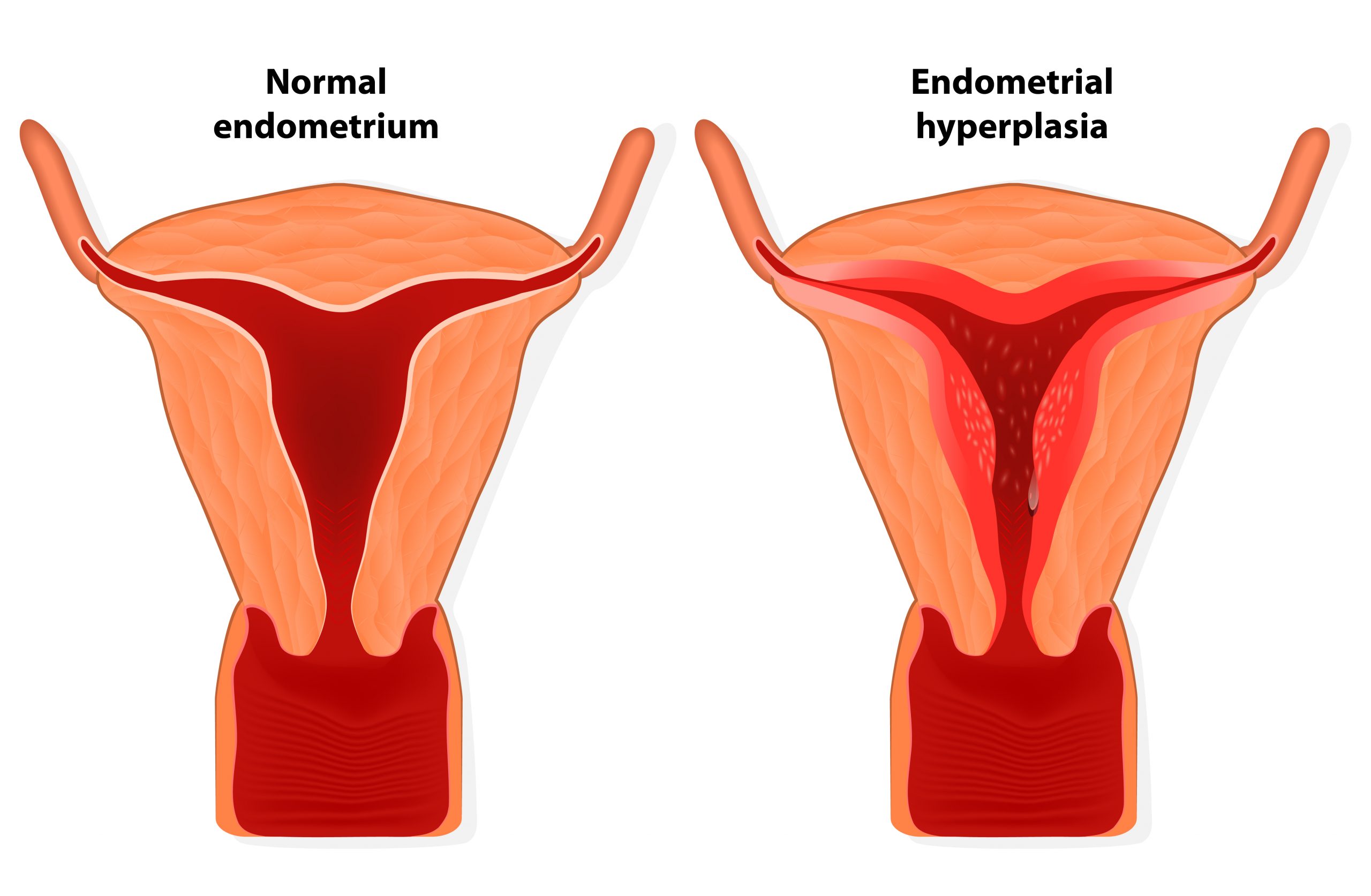 what-is-normal-endometrial-thickness-how-is-it-measured