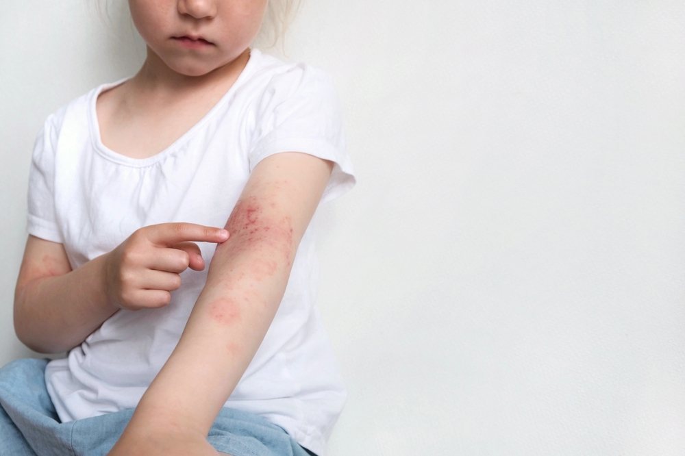 What Causes Pediatric (Childhood) Psoriasis?