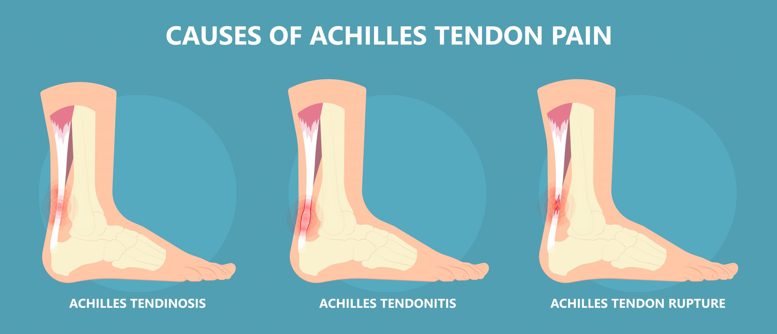 Achilles Tendon Injury: Symptoms, Causes, Treatment & Recovery