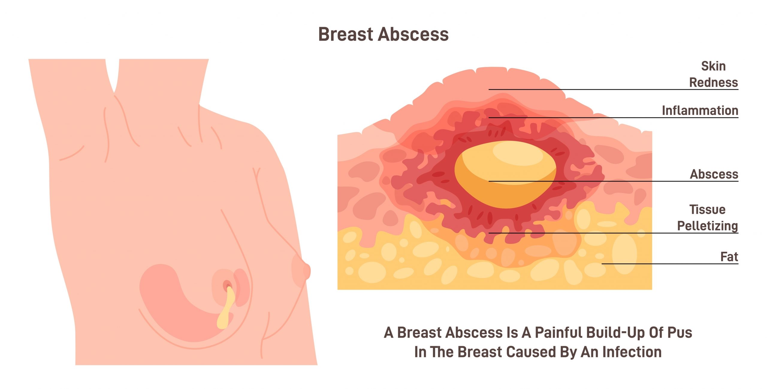 https://d3b6u46udi9ohd.cloudfront.net/wp-content/uploads/2023/09/05105523/What-is-a-breast-abscess-scaled.jpg