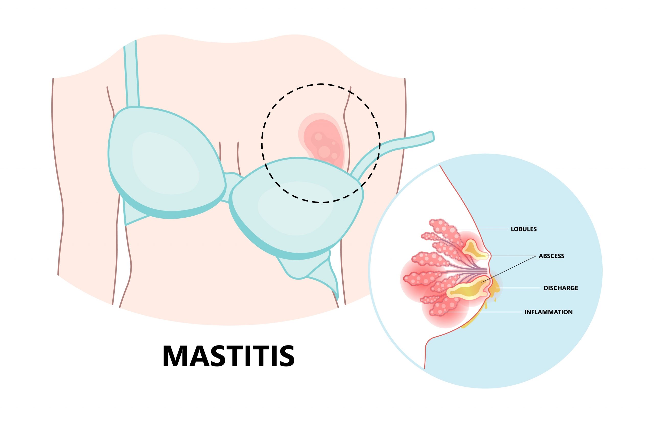 Mastitis During Breastfeeding: Symptoms and Support Strategies