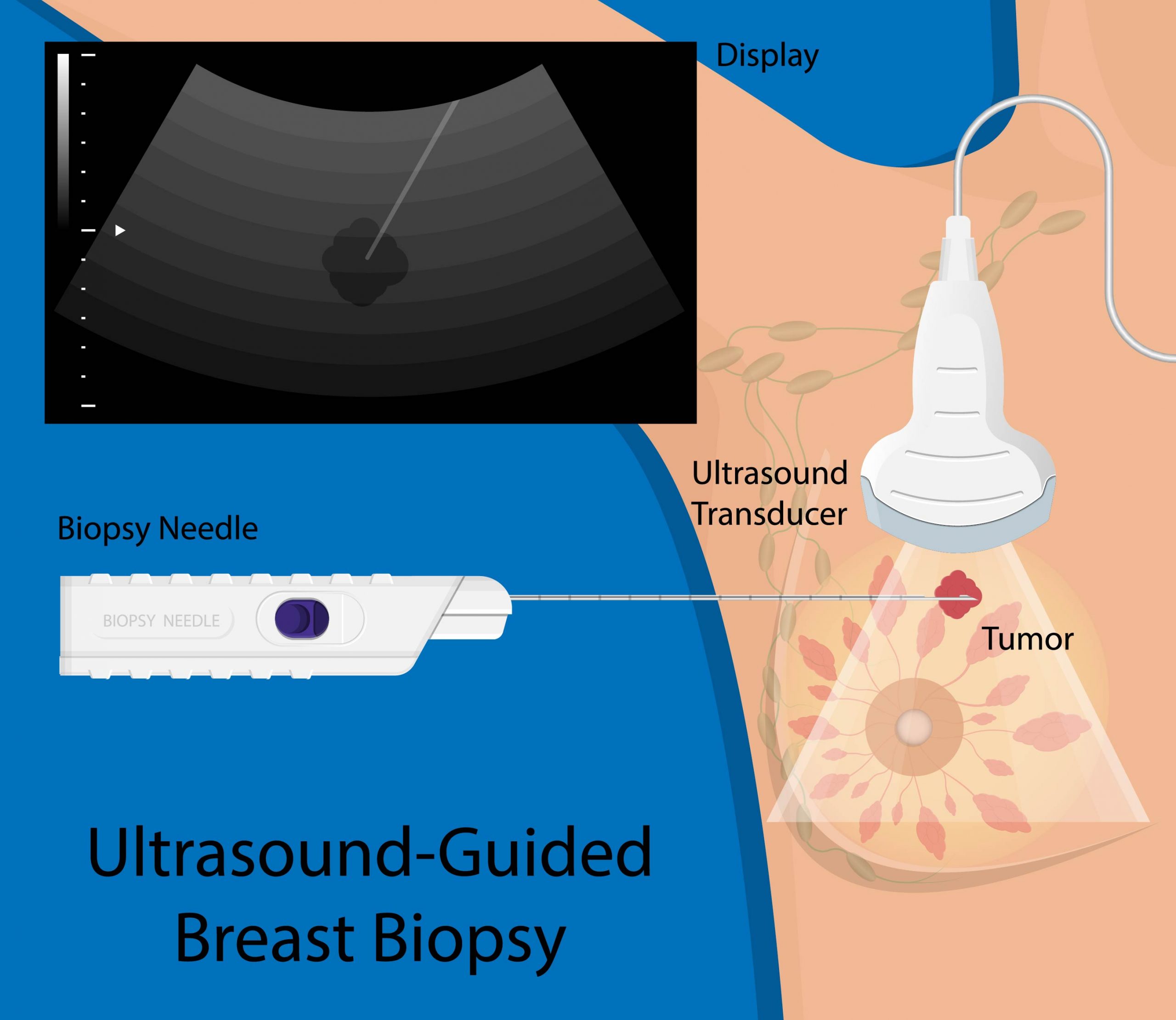 Fine Needle Aspiration for Breast Biopsy: Procedure, Side Effects