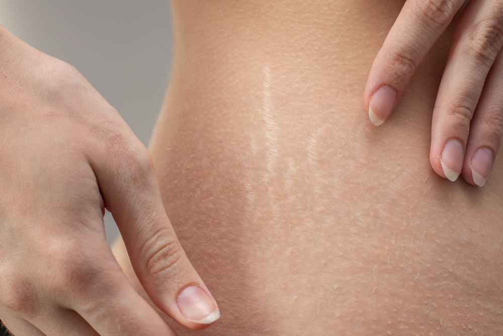 Cream can help avoid stretch marks